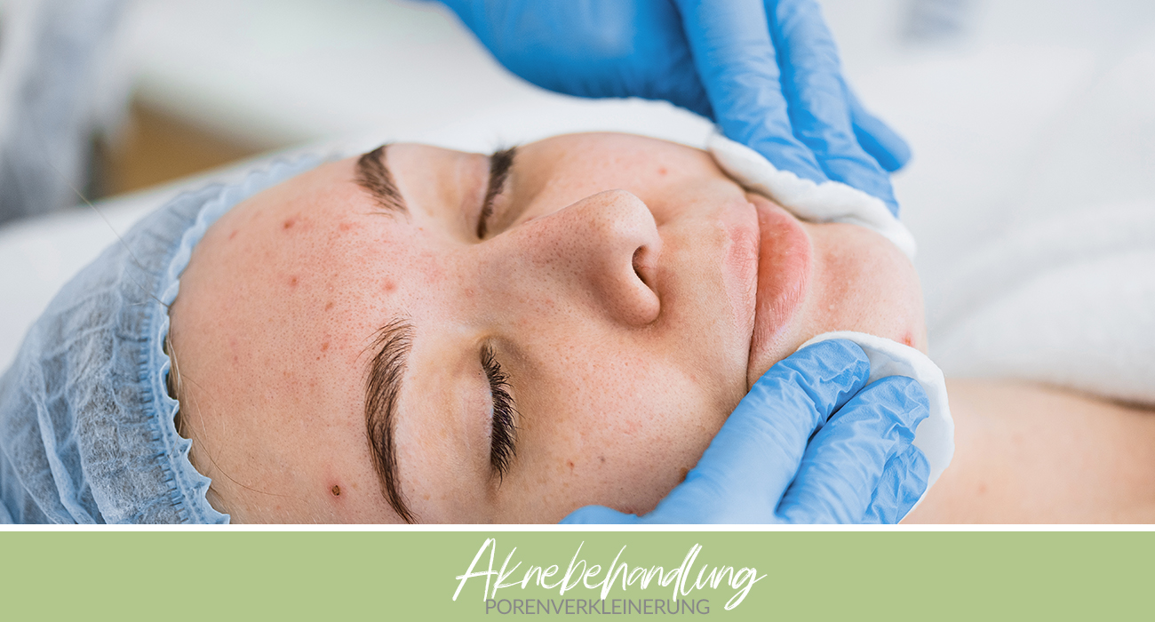 Aknebehandlung